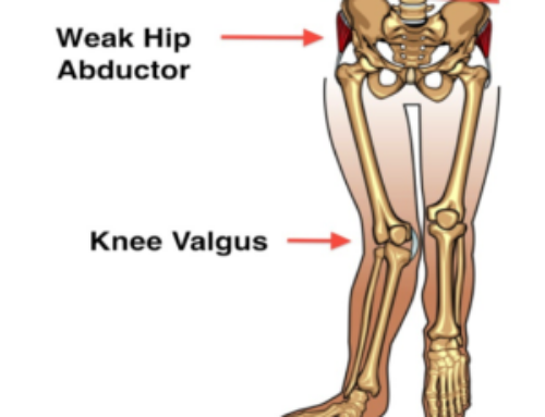 Hip Abductor Weakness