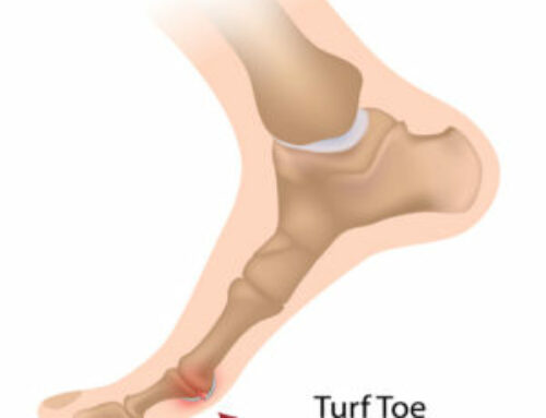 Turf Toe