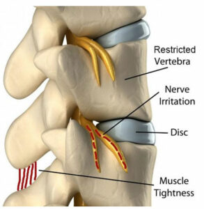 low-back-pain