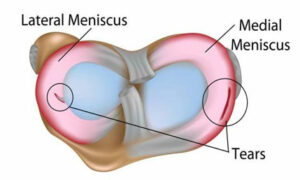 meniscus-injury