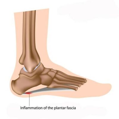 plantar-fasciitis