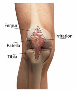runners-knee