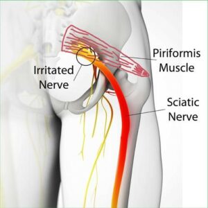 sciatica
