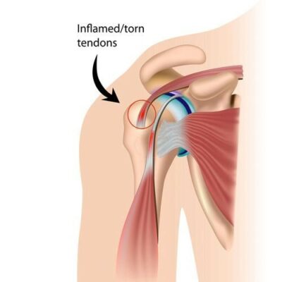 shoulder-pain