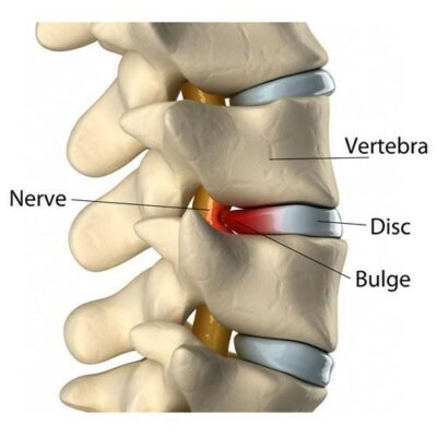 What Type of Back Pain Do You Have?