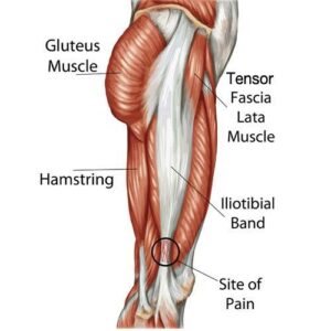 Iliotibial Band Syndrome West Des Moines IA