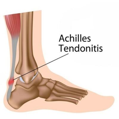 achilles-tendonitis