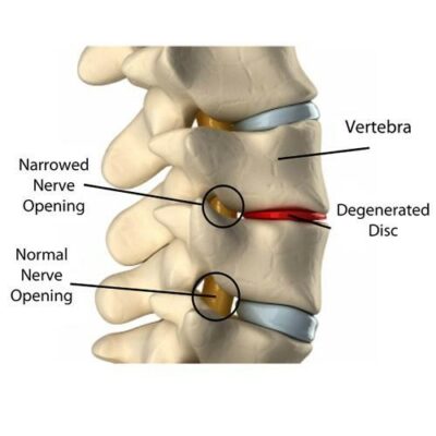 Arthritis