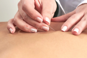 Acupuncture Treatment in West Des Moines, IA
