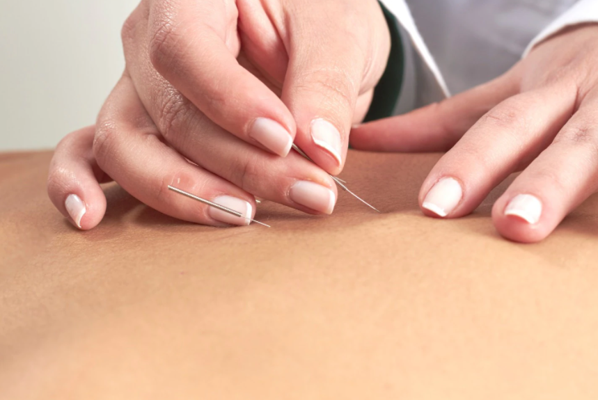 Acupuncture Services and Treatment in West Des Moines, IA