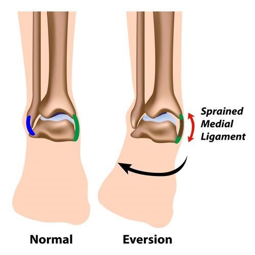 Ankle Sprain or Strain Recovery West Des Moines IA