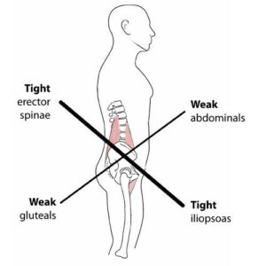 lower Crossed syndrome