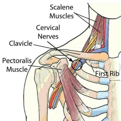 thoracic outlet syndrome