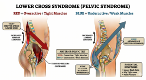 Lower Crossed Syndrome