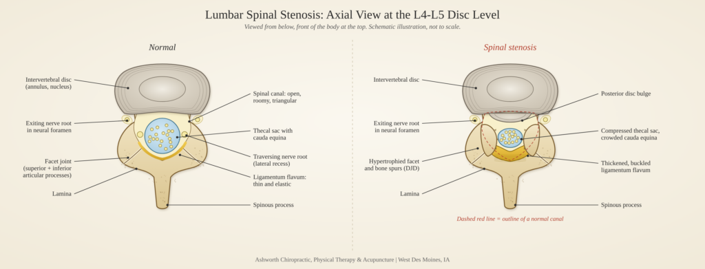 lumbar spinal stenosis